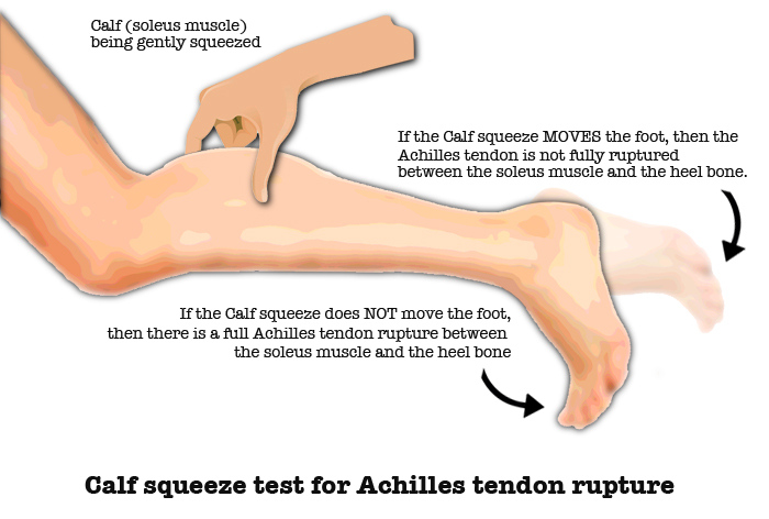  OrthoSleeve Orthopedic Brace for Tendinitis, Arthritis